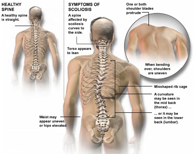 Signs of Scoliosis